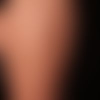 Lipoatrophia semicircularis: a completely asymptomatic, streaky, non-hardened lipatrophy on the o...