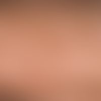 Chronic light damage: poikiloderma after years of excessive UV exposure, including hyperpigmentat...