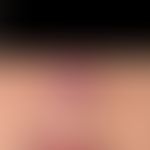 Lupus pernio: 63-year-old female patient with reddish-livid plaque of the nose and previously kno...