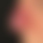 Lupus pernio: 63-year-old female patient with reddish-livid plaque of the nose and previously kno...