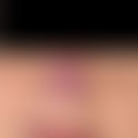 DD: Rosacea erythematos- hier Lupus pernio: 63 Jahre alte Patientin mit rötlich-livider Plaque de...