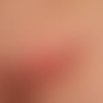 Lymphogranuloma inguinale: Inflammatory swollen lymph nodes in the groin area (bubo) in a 26-year...
