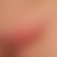 Lymphogranuloma inguinale: Inflammatory swollen lymph nodes in the groin area (bubo) in a 26-year...