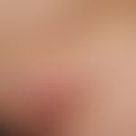 Lymphogranuloma inguinale: Inflammatory swollen lymph nodes in the inguinal region (bubo) in a 26...