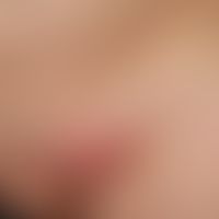 Lymphogranuloma inguinale. Entzündlich geschwollener Lymphknoten im Leistenbereich (Bubo) bei ein...