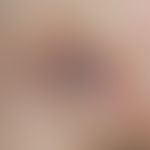 Lymphogranuloma inguinale: Abscessing lymphadenitis of the groin (Bubo). 32-year-old patient (sta...