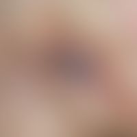 Lymphogranuloma inguinale: Abscessing lymphadenitis of the groin (Bubo). 32-year-old patient (sta...