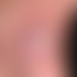 Mycobacterium marinum/Mykobakteriosen, nichtuberkulöse (atypische):&nbsp;seit mehreren Monaten be...