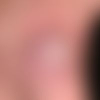 mycobacterioses, atypical. for several months existing, scaly, painless, blurred red lump. infect...