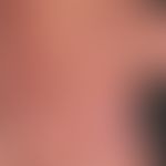 Mycobacterium marinum/Mykobakteriosen, nichtuberkulöse (atypische):&nbsp;seit mehreren Monaten be...