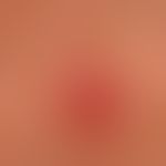 Mycobacterium marinum: chronischer&nbsp; (seit etwa 8 Wochen bestehender, insuffizient vorbehande...