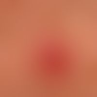 Mycobacteriosis atypical: chronic (existing for about 8 weeks, insufficiently pre-treated) painle...