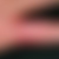 Mycobacterium marinum/Mykobakteriose atypische: chronische, rote, im Zentrum verruköse, ansonsten...