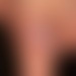 Mycobacterium marinum/Mykobakteriosen, nichtuberkulöse (atypische):&nbsp;Seit 3 Monaten bestehend...