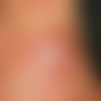Mycobacterioses, atypical. swimming pool granulomas: In a period of 6-8 months development of pai...