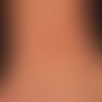 Mycobacterium marinum/Mykobakteriose atypische: chronischer&nbsp; (seit etwa 8 Wochen bestehender...