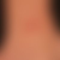 Mycobacteriosis atypical: chronic (existing for about 8 weeks, insufficiently pre-treated) painle...
