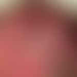 Melanosis neurocutanea, detailed picture with multiple, sharply defined, pigmented, black spots a...