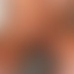 Nevus melanocytic congenital bathing trunk nevus: congenital, large melanocytic nevus on the trun...