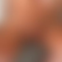 Nevus melanocytic congenital bathing trunk nevus: congenital, large melanocytic nevus on the trun...