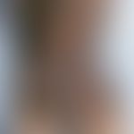 Nevus, melanocytic, congenital, swimming trunks type; large, irregularly pigmented melanocytic ne...