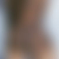 Nevus, melanocytic, congenital, swimming trunks type; large, irregularly pigmented melanocytic ne...