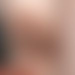 Naevus melanozytärer kongenitaler: großer, kongenitaler, behaarter melanozytärer Naevus. Keine Ve...