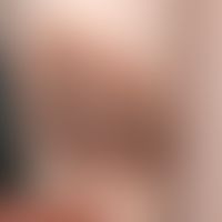 Nevus melanocytic congenital: large, congenital, hairy melanocytic nevus. No changes during the a...