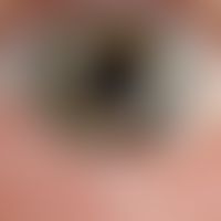 Nevus melanocytic congenital of the iris
