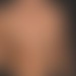 Naevus melanozytärer kongenitaler: halbseitig (Schachbrettmuster eines kutanen Mosaiks)&nbsp;loka...