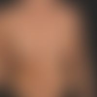 Nevus melanocytic congenital: half-sided (checkerboard pattern of a cutaneous mosaic) localized c...