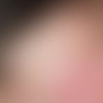 Naevus spilus. pigmentation spot existing since birth, increasing splatter-like pigmentation in t...