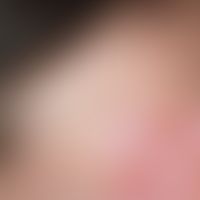 Naevus spilus. Seit Geburt bestehender Pigmentfleck, zunehmende spritzerartige Pigmentierung in d...