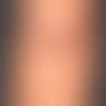 Naevus spilus, a light brown large pigmentation spot with splashes of dark pigmentation that has ...
