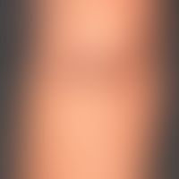 Naevus spilus:&nbsp;Seit Geburt bestehender hellbrauner großflächiger&nbsp;Pigmentfleck mit sprit...