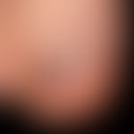 Hämatom, Nagelhämatom: deutlich nach allen Seiten hin begrenzte Nagelverfärbung. S. nächste Abb. ...