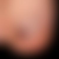 Hematoma, nail hematoma: clearly limited nail discoloration in all directions, see next figure wi...