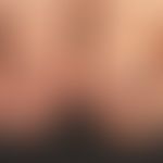 Nagelhämatome: beidseitige, zu den Seiten und nach vorne hin, scharf begrenzte Verfärbungen der G...