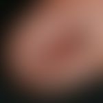 Differenzialdiagnose Nagelhämatom 

Diagnose: Melanonychia longitudinalis: Typischer Befund einer...