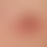 mastitis. solitary, acute, surrounding the areola mamillae, approx. 3.0 cm in size, blurredly lim...