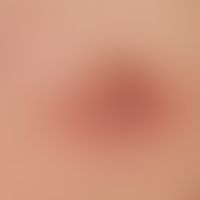 mastitis. solitary, acute, surrounding the areola mamillae, approx. 3.0 cm in size, blurredly lim...