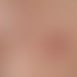 mastitis. solitary, acute, surrounding the areola mamillae, approx. 3.0 cm in size, blurred, firm...