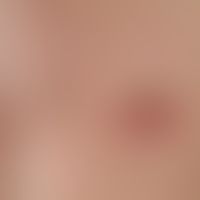 mastitis. solitary, acute, surrounding the areola mamillae, approx. 3.0 cm in size, blurred, firm...