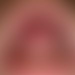 Lichen planus (classic type): veil-like, whitish, blurred, symptomless plaques on the hard and so...
