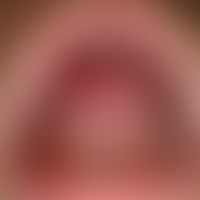 Lichen planus (classic type): veil-like, whitish, blurred, symptomless plaques on the hard and so...