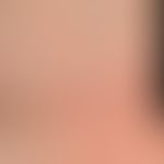 Lichen planus (classic type): discrete expression, for several weeks, red, itchy, polygonal, in p...