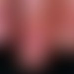 Lichen planus (classic type):  Nail infestation with longitudinal stripes, atrophy of the nails a...