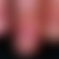 Lichen planus (classic type):  Nail infestation with longitudinal stripes, atrophy of the nails a...