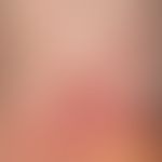 Lichen planus classic type: for several weeks persistent, red, itchy, polygonal, partially conflu...