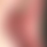 Lichen planus mucosae: whitish-grey, reticular, reticular change of the cheek mucosa.
